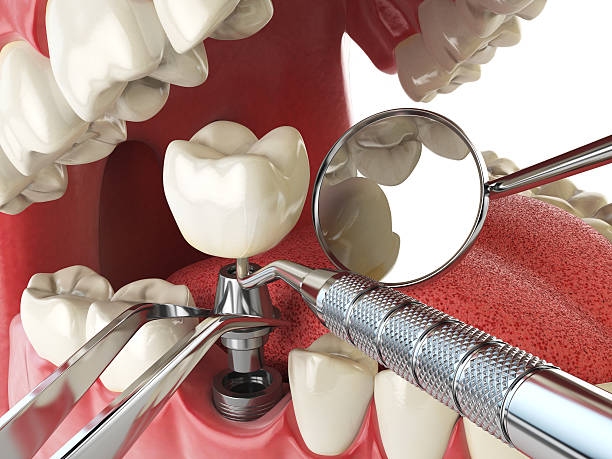 Best Emergency Wisdom Tooth Extraction in Suffield Depot, CT
