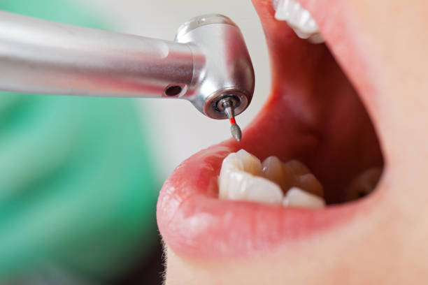 Best Broken or Chipped Tooth Repair in Suffield Depot, CT